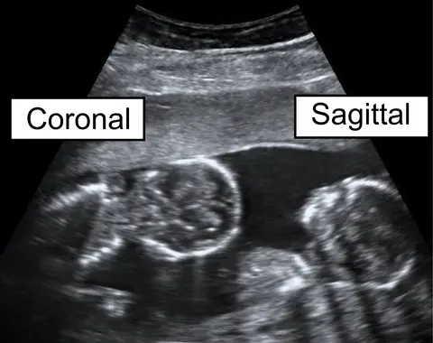 초음파: 임신 15주 쌍둥이 태아의 관상면과 시상면