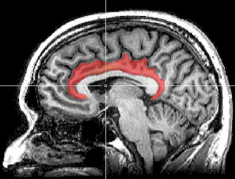 MRI: 띠이랑겉질의 위치(시상면)
