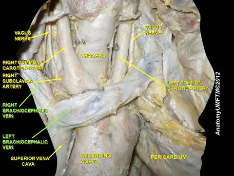 해부 사진: Brachiocephalic vein