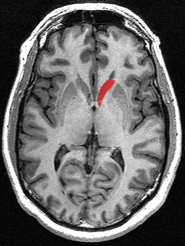 MRI: 꼬리핵의 구조 영상(가로단면)