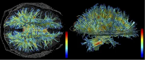 MRI: 사람 뇌 백색질 구조(오른쪽이 앞쪽)
