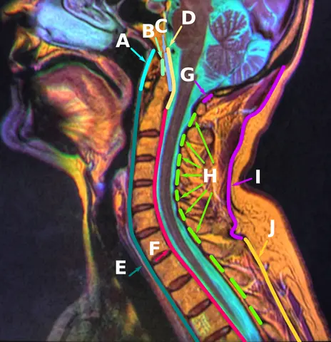 MRI: 목 인대 해부 — 앞뒤통수뼈막, 끝인대 등