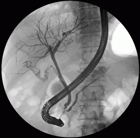 X선: 내시경 역행성 담췌관 조영술(ERCP) — 정상 담관·췌관과 여러 담석