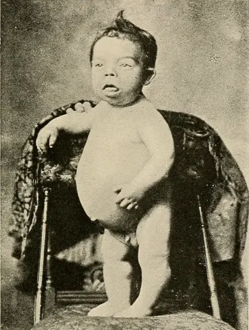 사진: 선천성 요오드 결핍 증후군을 앓는 아이(1917년 문헌)