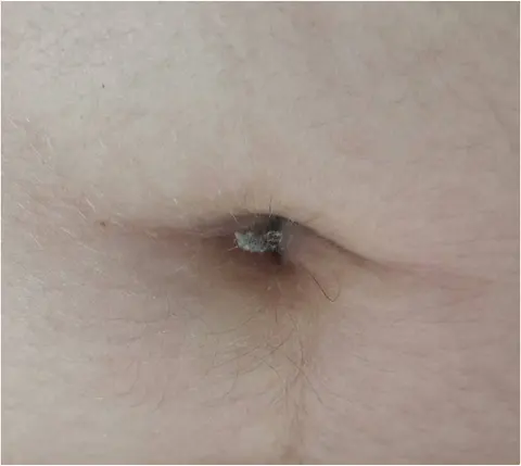 사진: 배꼽 먼지(비교 자료)