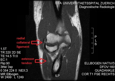 MRI: 정상 노쪽곁인대와 폄근힘줄(T1강조 팔꿈치)