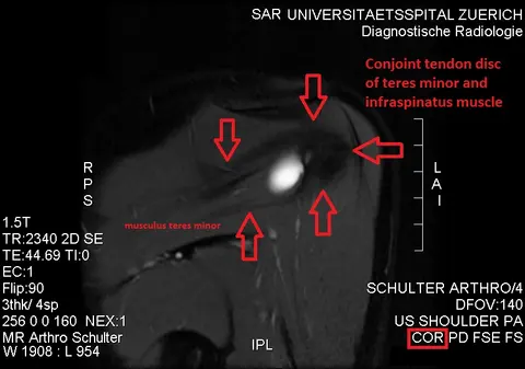 MRI: 작은원근과 가시아래근의 합쳐진 정상 힘줄판