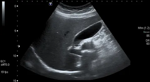 초음파: 복부 초음파로 본 쓸개와 온쓸개관