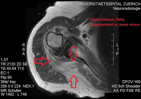 MRI: 지방 변성으로 고신호를 보이는 작은원근