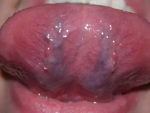 사진: 혀 아래면, 풍부한 혈관 분포