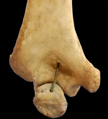 사진: 왼쪽 위팔뼈 먼쪽 뒷면(굽힌 상태)