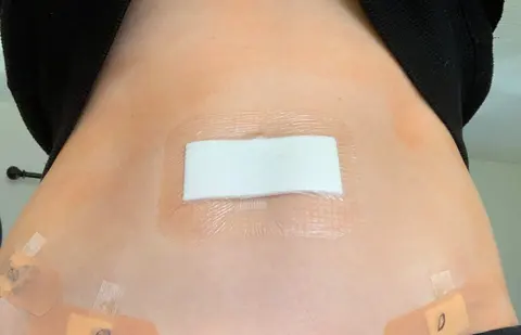 사진: 복강경 수술 후 여성의 배꼽