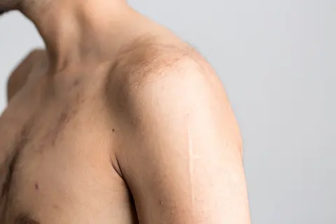 사진: 왼쪽 어깨