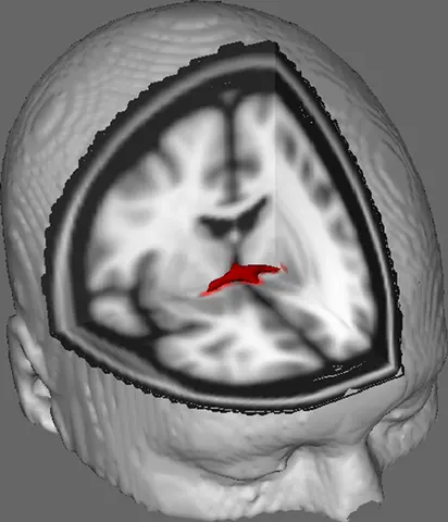 MRI: 정상 대조군 10명의 앞맞교차 확산텐서영상(평균 추적 결과)