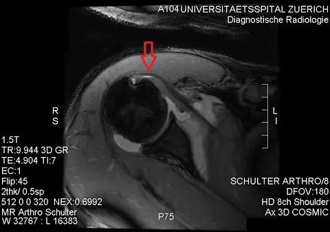 MRI: 어깨밑근힘줄 부착부 부분 파열