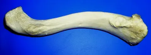 사진: 오른쪽 빗장뼈 아래면