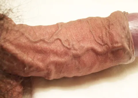 사진: 반발기 상태의 음경 — 깊은등쪽정맥과 등쪽동맥의 위치