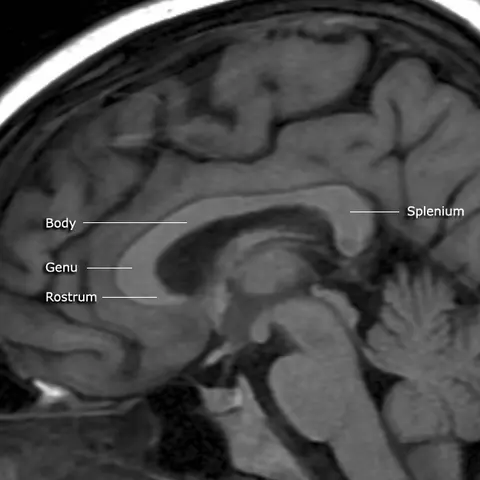 MRI: 뇌들보와 그 부분들