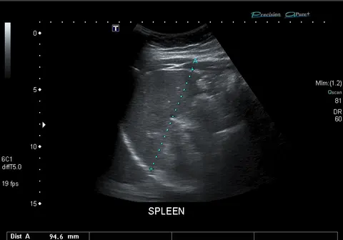 초음파: 복부 초음파로 본 지라
