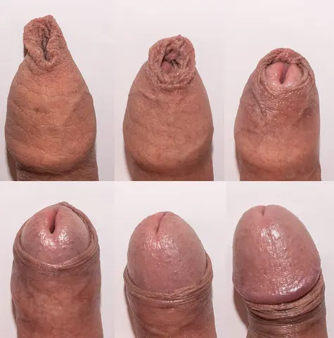 사진: 포피 젖힘 연속 사진(이완 상태에서 완전히 젖힌 상태까지)