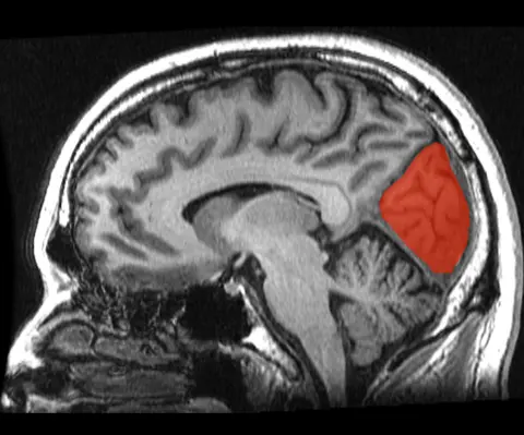 MRI: 시상면에서 쐐기소엽과 혀이랑(붉은색 표시)