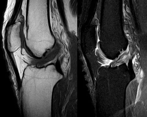 MRI: 앞십자인대 파열