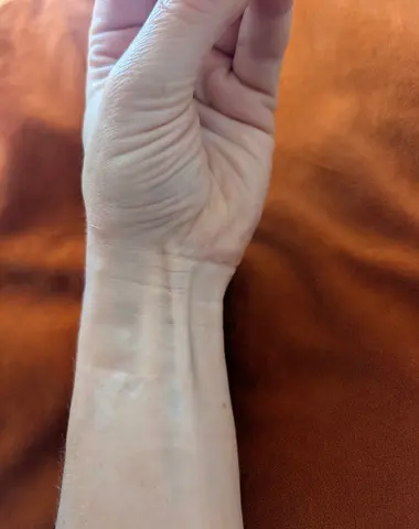 사진: 긴손바닥근힘줄, 양옆으로 굽힘근 힘줄