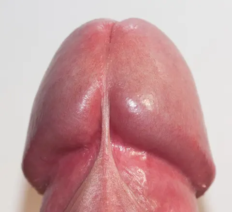 사진: 음경귀두 확대 — 포피소대가 온전함