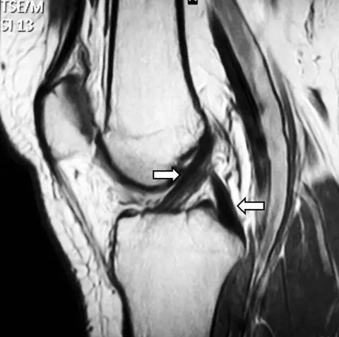 MRI: 앞십자인대와 뒤십자인대의 정상 신호