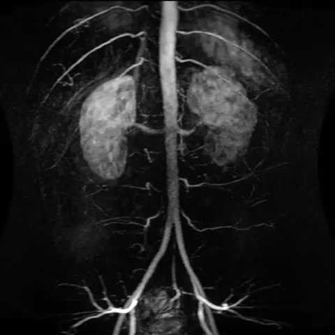 MRI: 조영 증강 자기공명혈관조영술로 본 정상 배대동맥과 쌍을 이룬 동맥