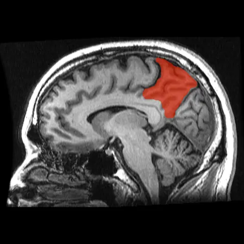 MRI: 시상단면에서 본 쐐기앞소엽(빨간색)