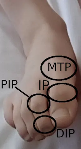 사진: 발가락 관절(DIP, PIP, IP, MTP) 명칭 표시